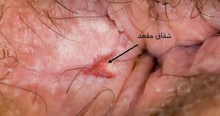درمان شقاق با طب سنتی - مدرسه طب - استاد حمید کافیان