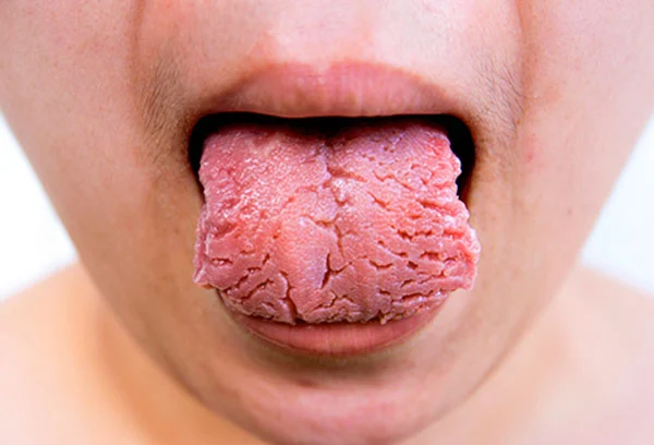 ترک و شکاف زبان از دیدگاه طب سنتی